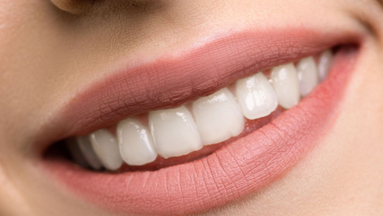 Strahlendes Lächeln mit Veneers